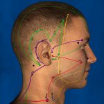 Meniere’s Disease